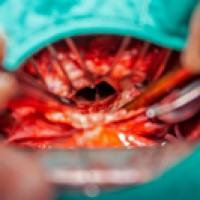 First stenotic mitral heart valve operations performed at Peter Bent Brigham