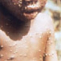 U.S. Department of Health and Human Services made more vaccine doses available to support Monkeypox response