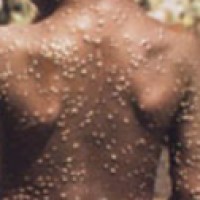 WHO informed of a confirmed case of monkeypox in an individual who travelled from the United Kingdom to Nigeria