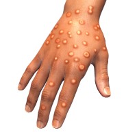 FDA authorized Monkeypox test