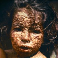 The World Health Assembly certified the world free of naturally-occurring smallpox