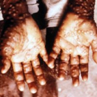 The World Heath Organization implemented vaccination program to eradicate smallpox from the world in ten years