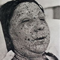 The last reported case of smallpox in the United States occurred