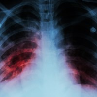 The CDC started a tuberculosis surveillance system in the US