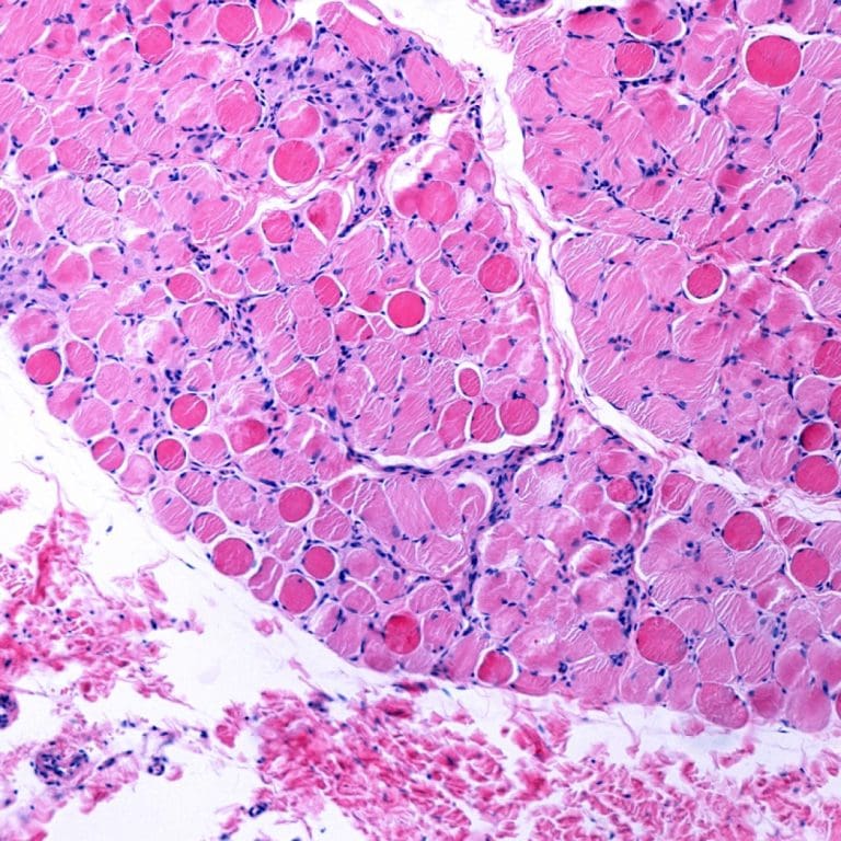 FDA approved targeted treatment for rare Duchenne Muscular Dystrophy mutation