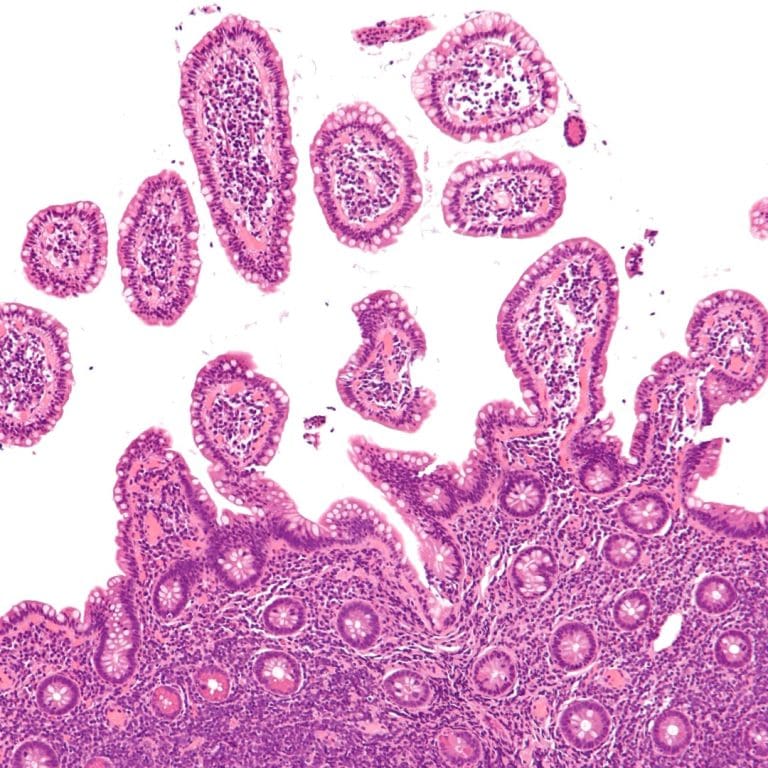 Genentech drug Polivy (polatuzumab vedotin-piiq) granted accelerated approval by FDA