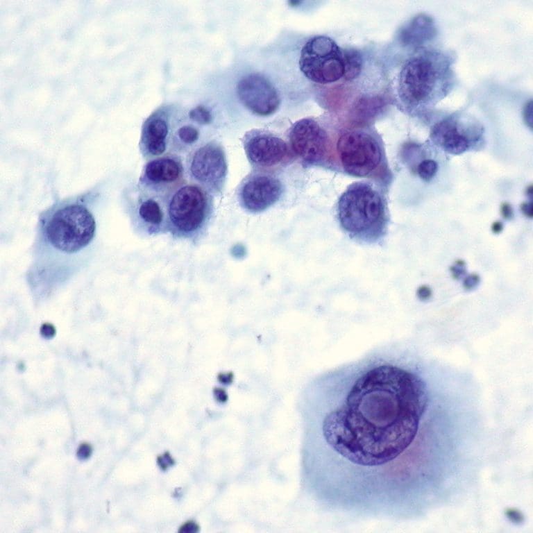 National Cancer Institute researchers found blocking a single protein proves toxic to myeloma cells in laboratory studies