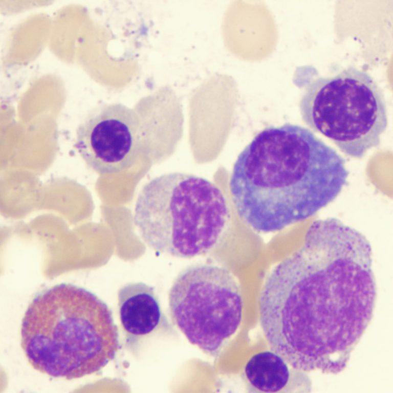 Multi-year, 1143-patient genetic study identified unique types of multiple myeloma