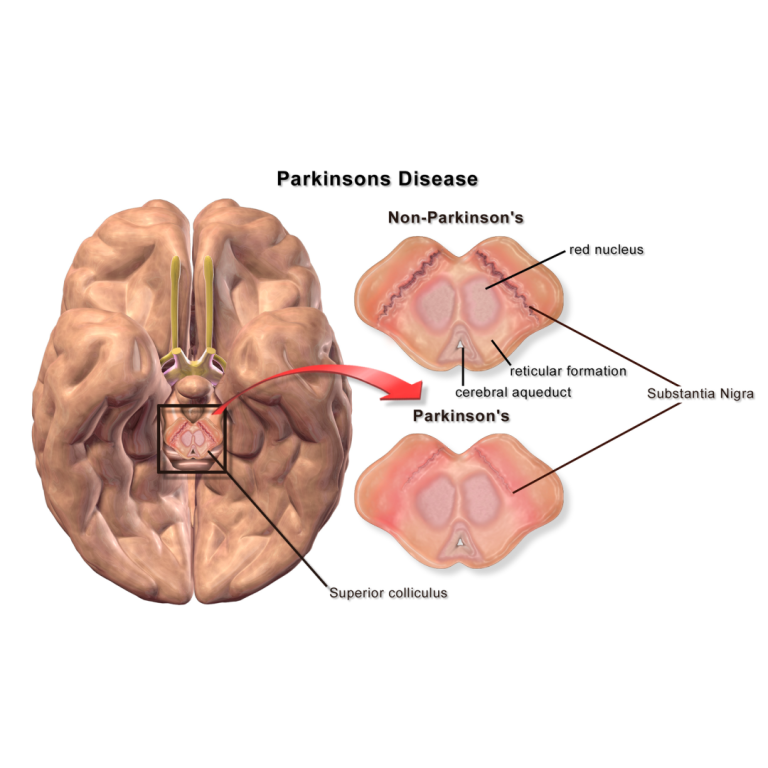 Researchers discover potential new target to treat Parkinson’s disease