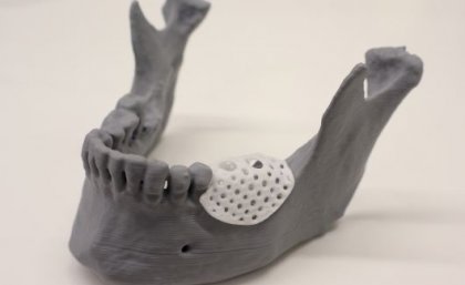 University of Queensland manufactures 3D printed scaffolding to rebuild jaw bones