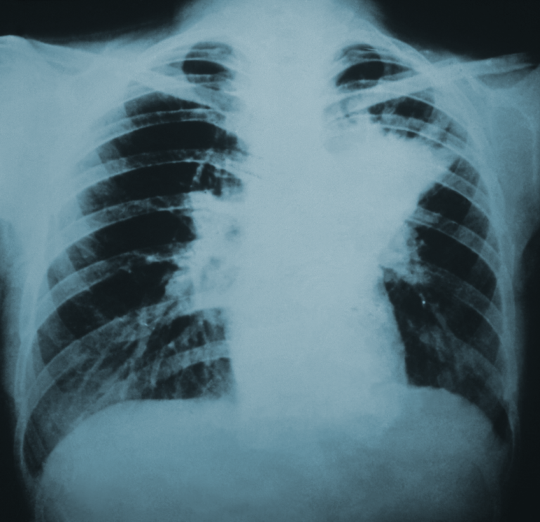 Largest Recorded Outbreak of Blastomycosis  in the U.S. Occurred in Michigan