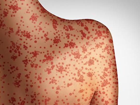 Texas Department of State Health reports measles Outbreak is Growing