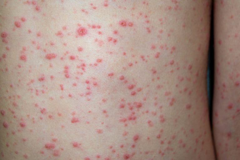 ACIP recommends second dose of varicella vaccine for children
