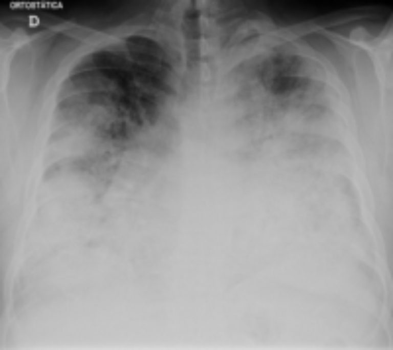 Two patient cases of Legionella pneumonia reported