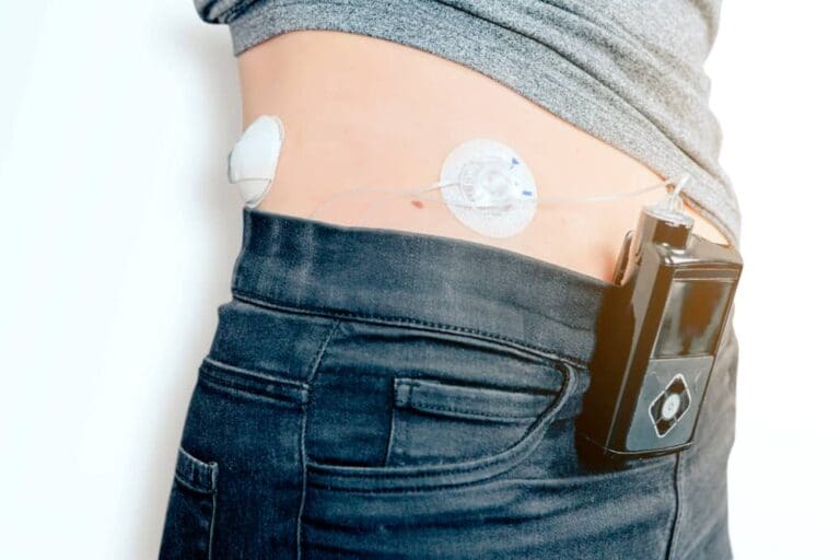 ‘Artificial pancreas’ transforming the lives of thousands of children and young people with type 1 diabetes