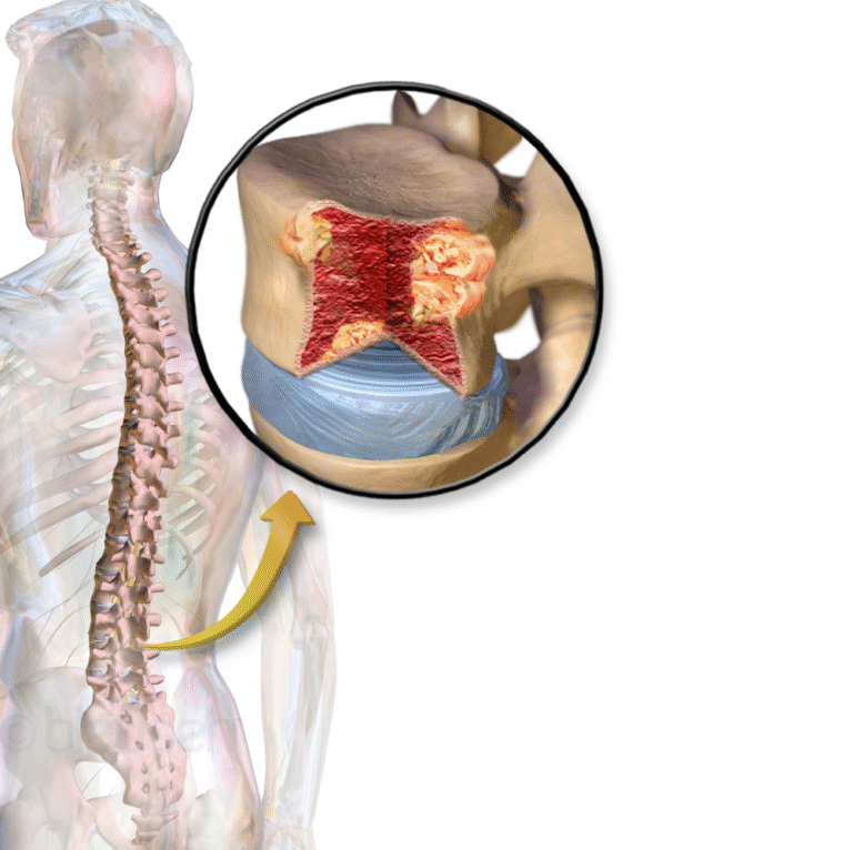 Blenrep approved by US FDA for use in treatment of relapsed/refractory multiple myeloma