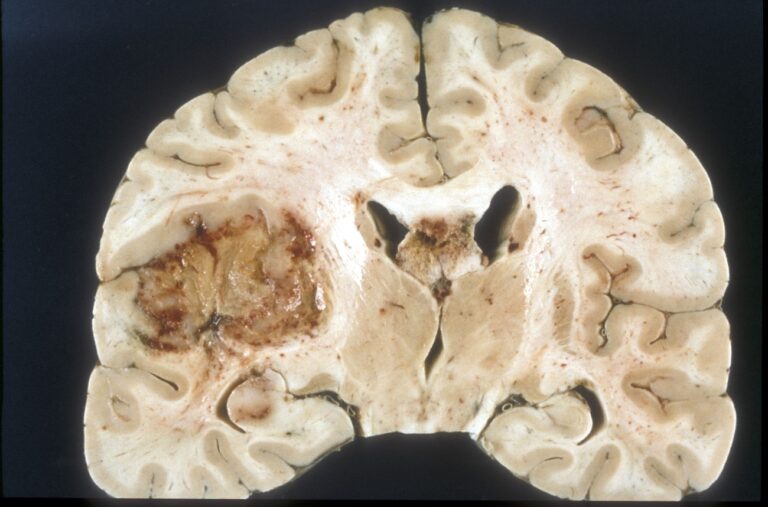 Last cell standing: world-first discovery uncovers how glioblastoma tumours dodge chemotherapy