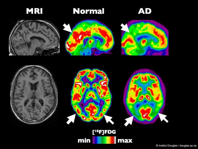 NIH study revealed how immune response triggered by COVID-19 may damage the brain