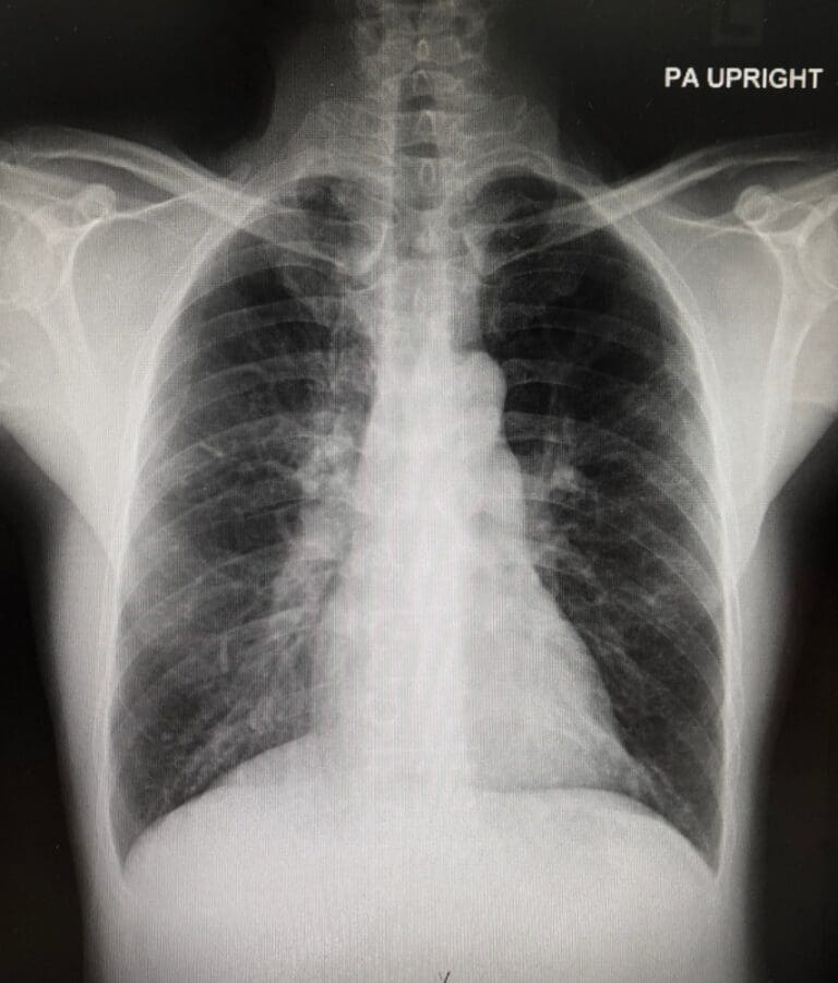 FDA approved first targeted therapy for subset of non-small cell lung cancer
