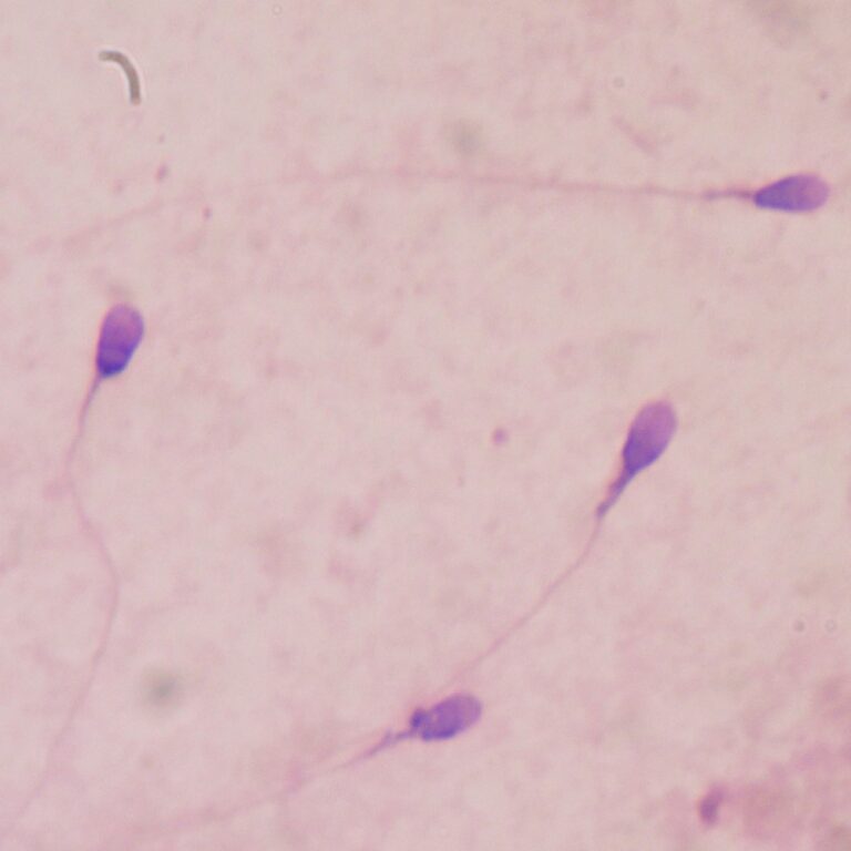 World first – First ever transplant of frozen testicular tissue after chemotherapy during childhood provides hope for fertility restoration