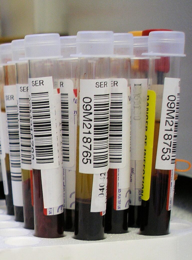 Blood-Based Test Can Predict Risk of Developing Symptoms of Alzheimer’s Up to a Decade Early