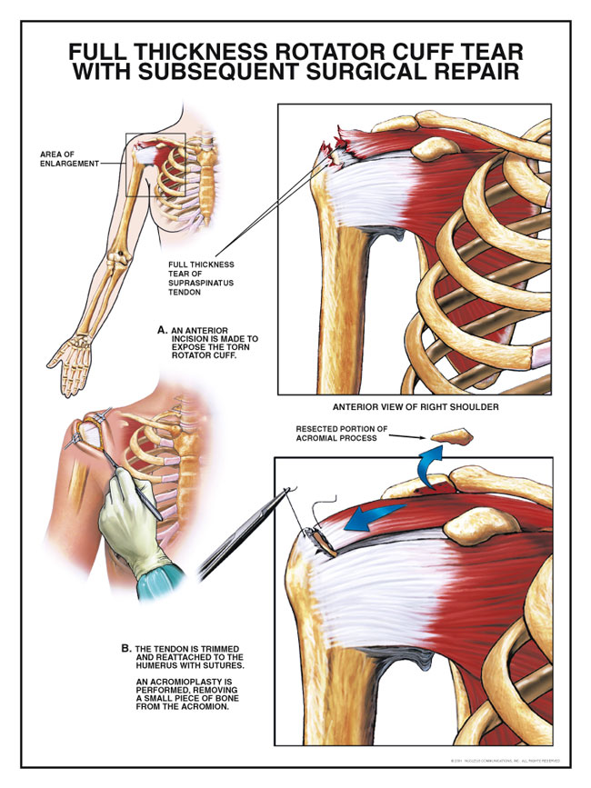 Mimicking natural connections could improve rotator cuff repair